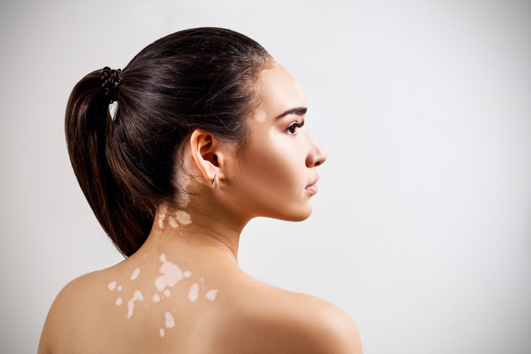 Vitiligo İçin Okunacak Dua?