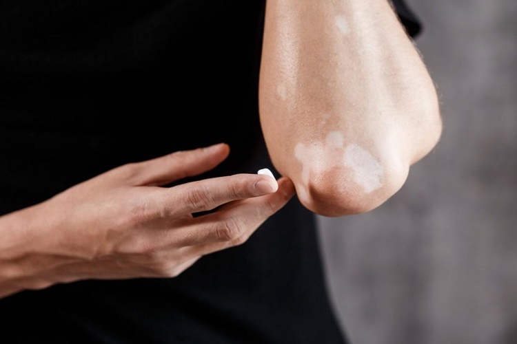 Vitiligo’nun Psikolojik Nedenleri Nelerdir?