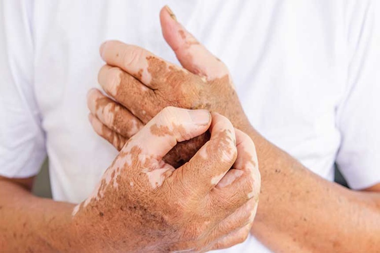 Vitiligo Öldürür Mü?