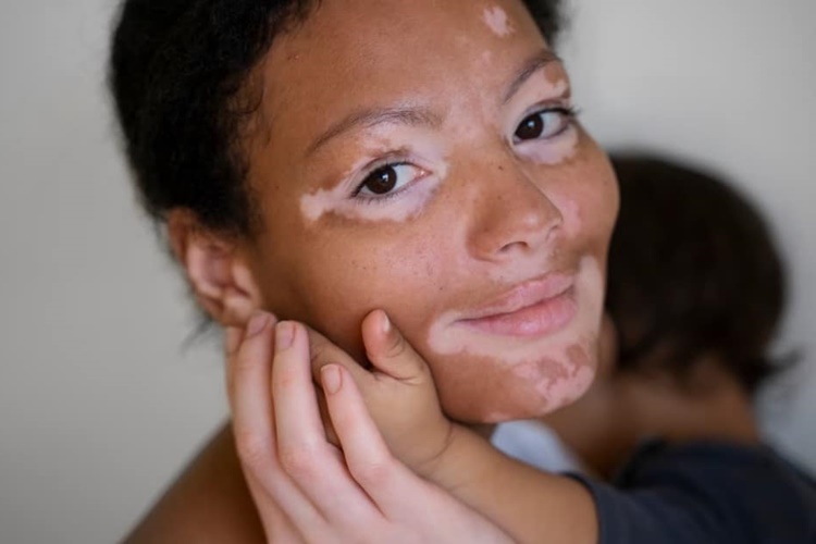 Vitiligo Sonradan Olur Mu?