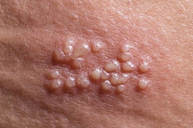Yanakta Uçuk Neden Çıkar?