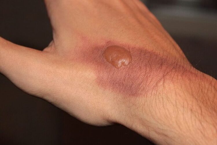 Yanık Sonrası Su Toplaması Neden Olur?