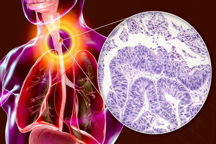 Yemek Borusuna Stent Takıldıktan Sonra Ağrı Nasıl Geçer