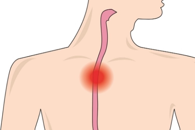 Yemek Borusuna Stent Takıldıktan Sonra Tıkanma Olur Mu?