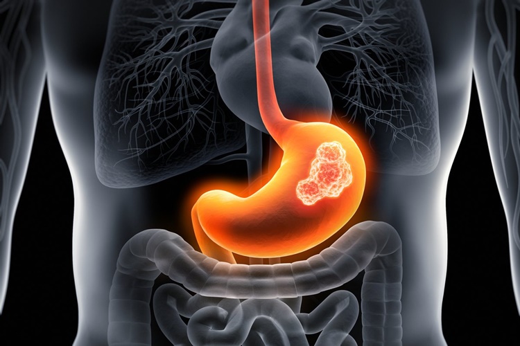 Yemek Borusuna Stent Takıldıktan Sonra Uçak Yolculuğu Yapılır Mı?