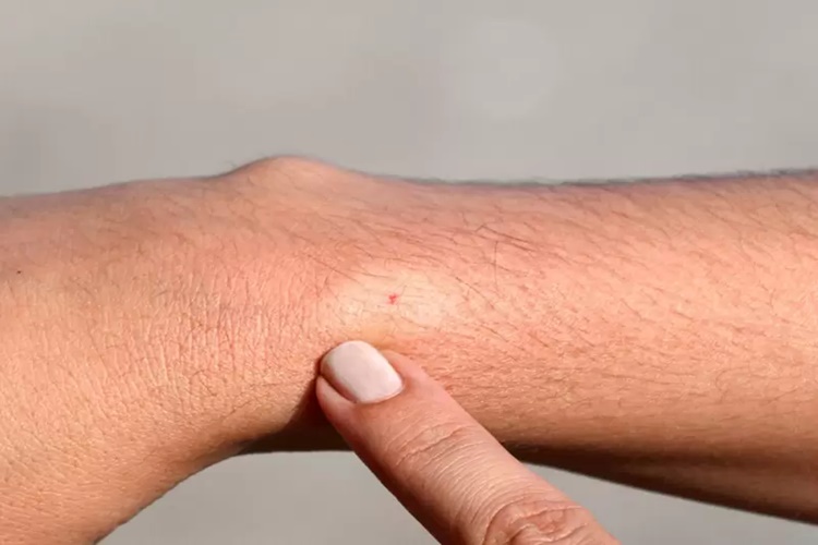Zalain Krem Şişliğe İyi Gelir Mi?