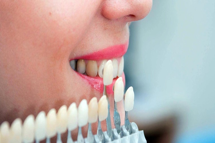 Zirkon Kaplama Nasıl Yapılır?