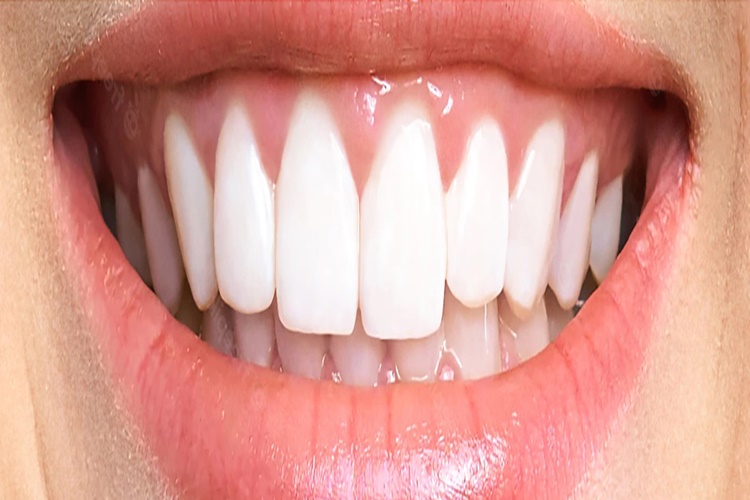 Zirkon Kaplama Nedir?