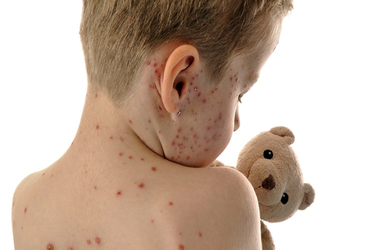 Zona Hastalığı Antibiyotik?