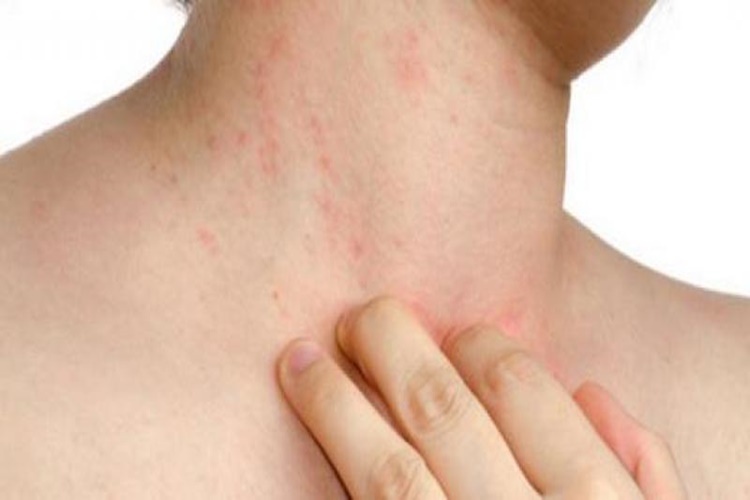 Zyrtec Alerji Yapar Mı?